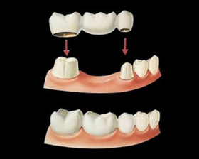 Prótese Dental